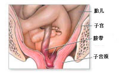 什么叫脐带脱垂?和田妈妈如何预防脐带脱垂?